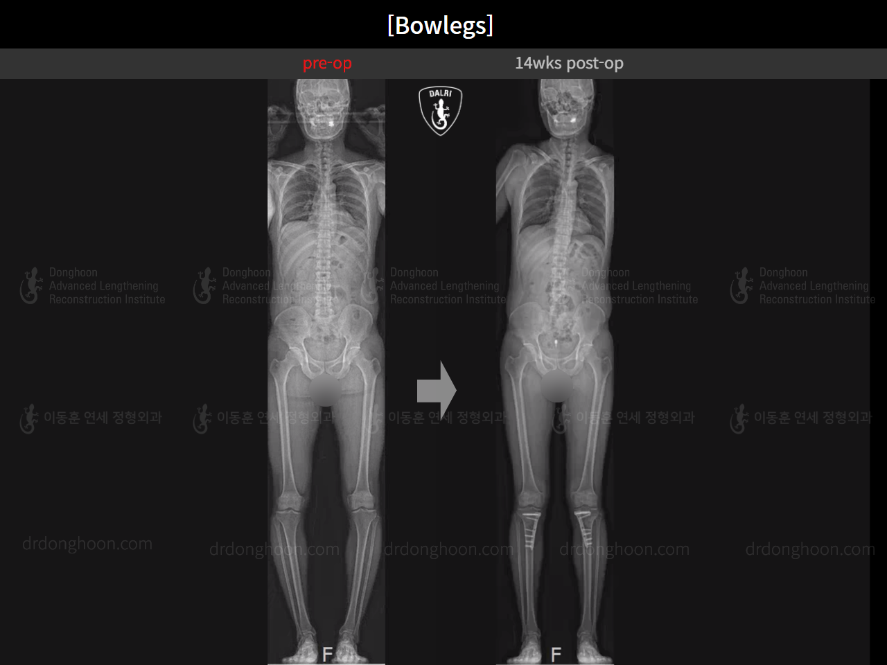 Before and after adult bowlegs, case 15512423, image 11, Dr. Donghoon institute (DALRI)