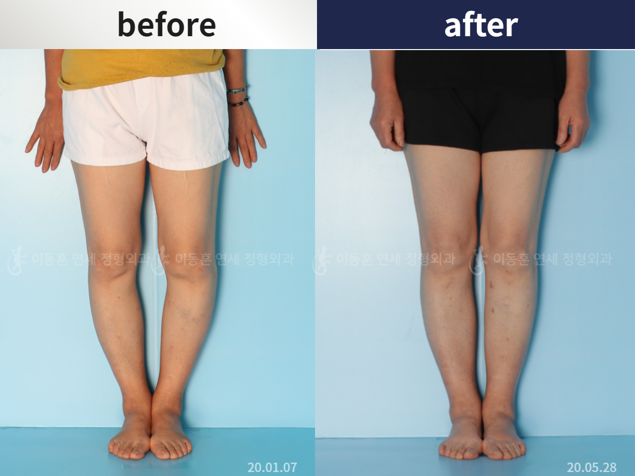 Before and after flexion deformity, case 5987528, image 2, Dr. Donghoon institute (DALRI)