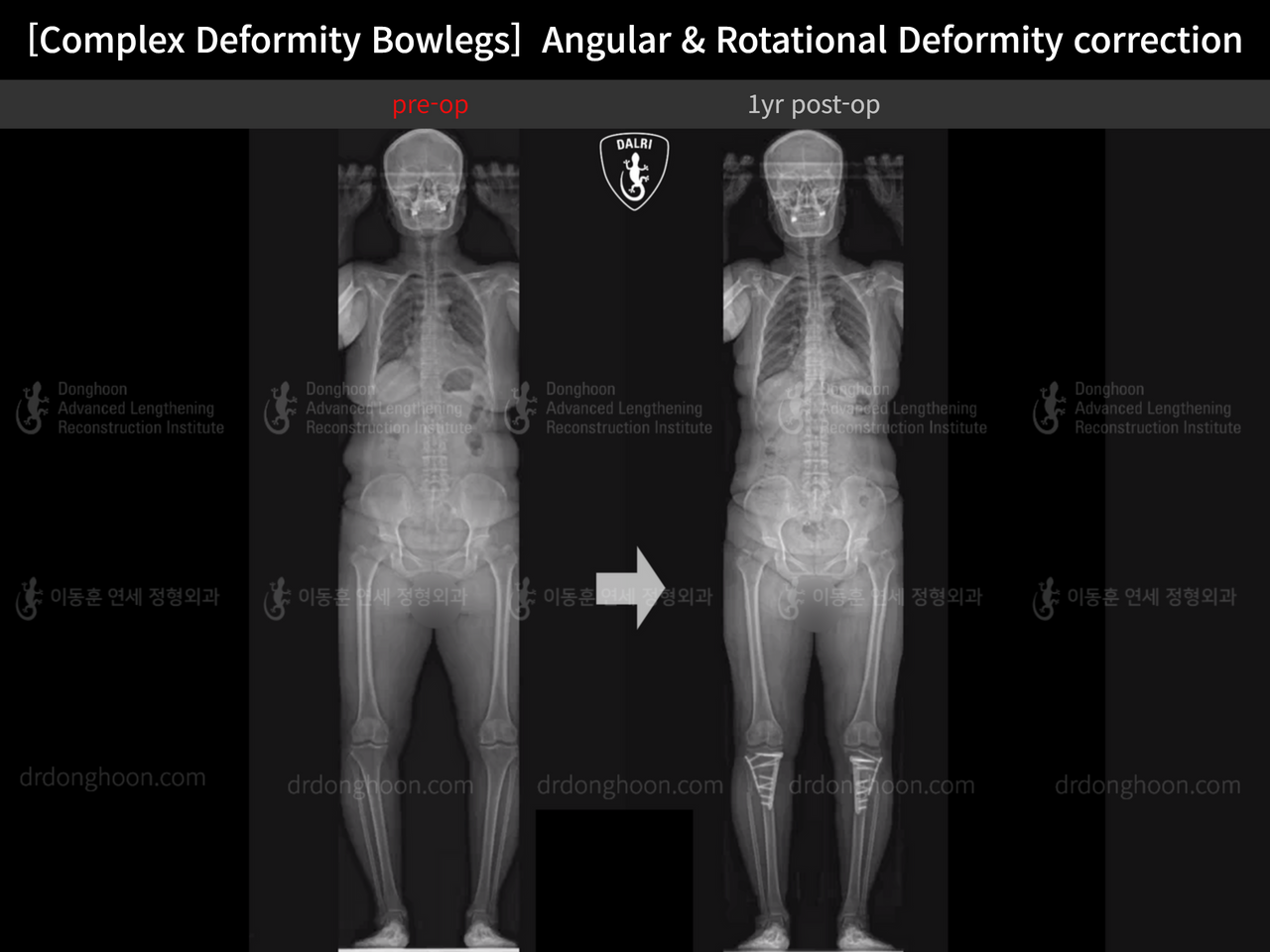 Before and after adult bowlegs, case 14378683, image 7, Dr. Donghoon institute (DALRI)