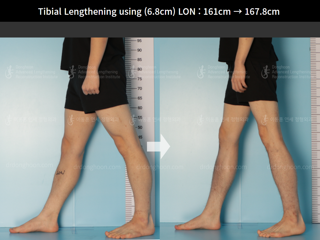 Before and after cll lon, case 8663720, image 7, Dr. Donghoon institute (DALRI)