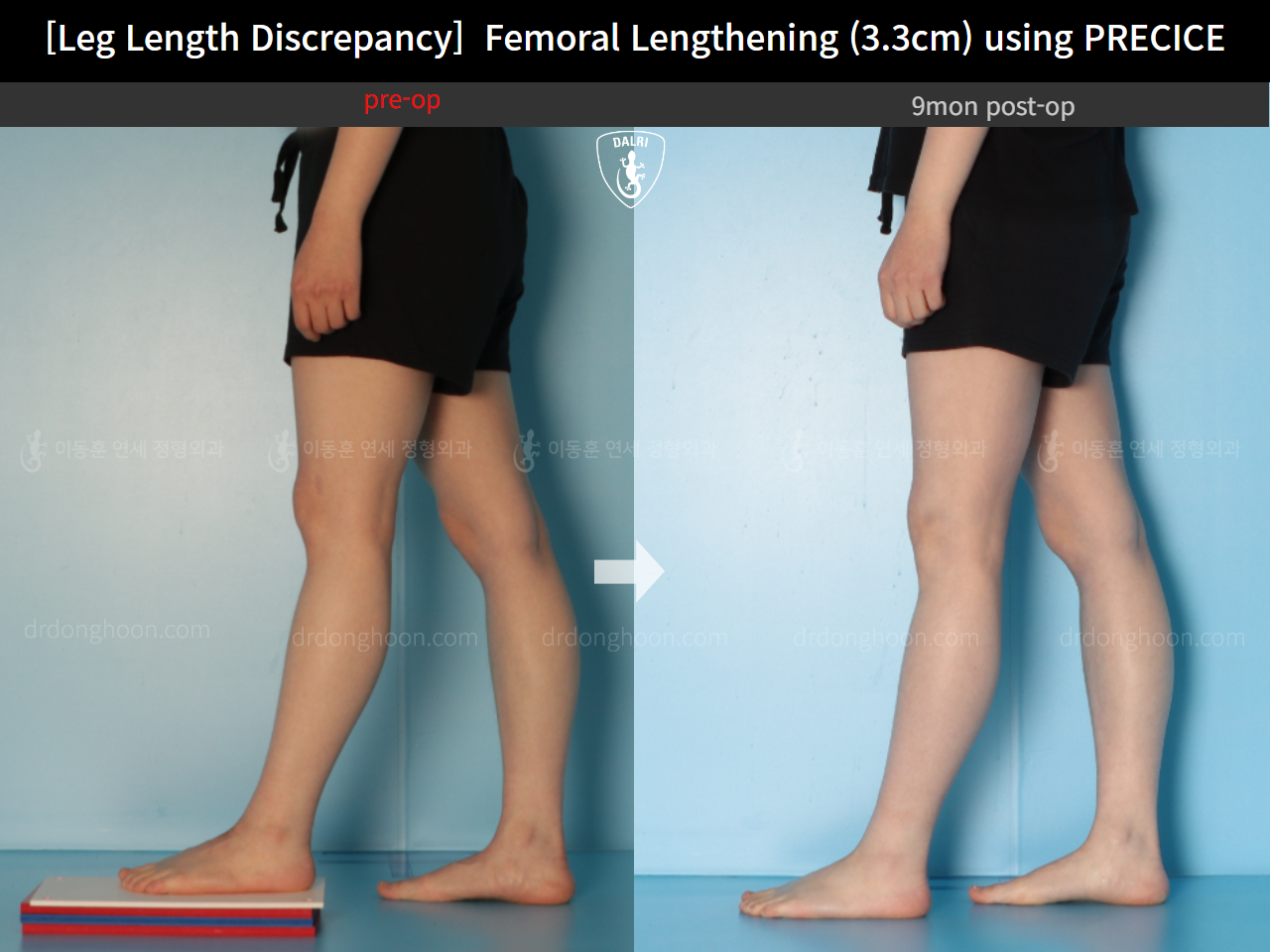 Before and after adult lld, case 14602297, image 8, Dr. Donghoon institute (DALRI)