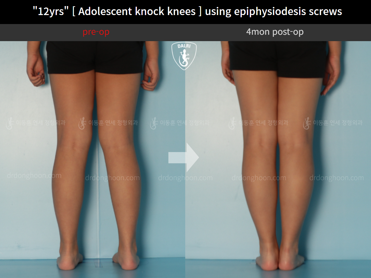 Before and after paediatric & adolescent knock knees, case 11772917, image 4, Dr. Donghoon institute (DALRI)