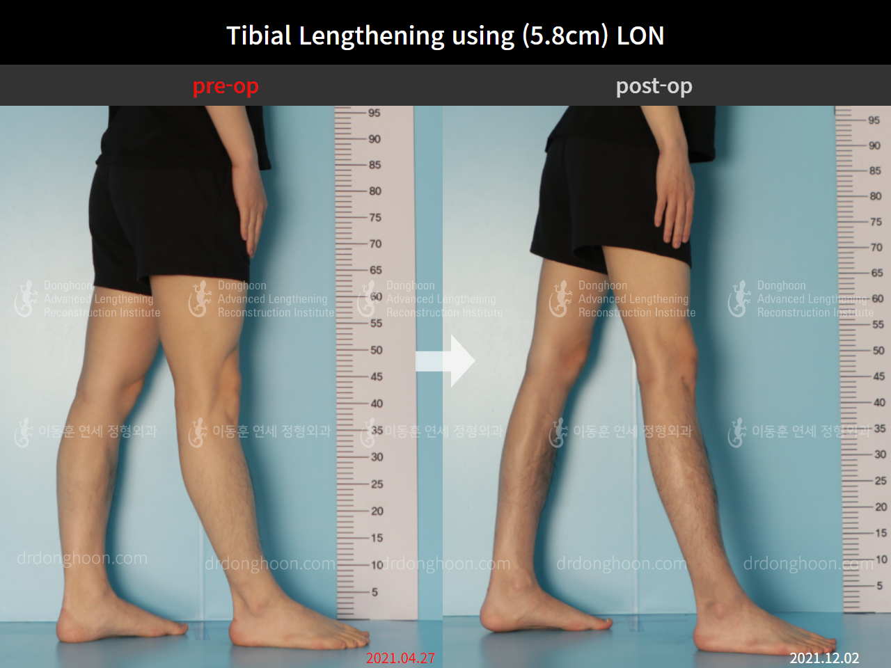 Before and after cll lon, case 9047470, image 5, Dr. Donghoon institute (DALRI)
