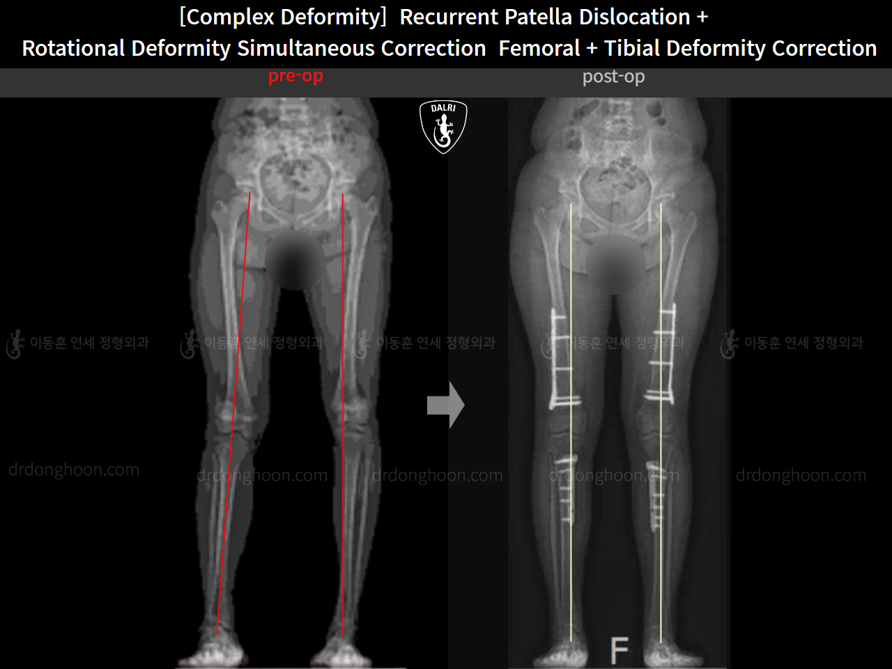 Before and after recurrent patella dislocation, case 16298897, image 9, Dr. Donghoon institute (DALRI)
