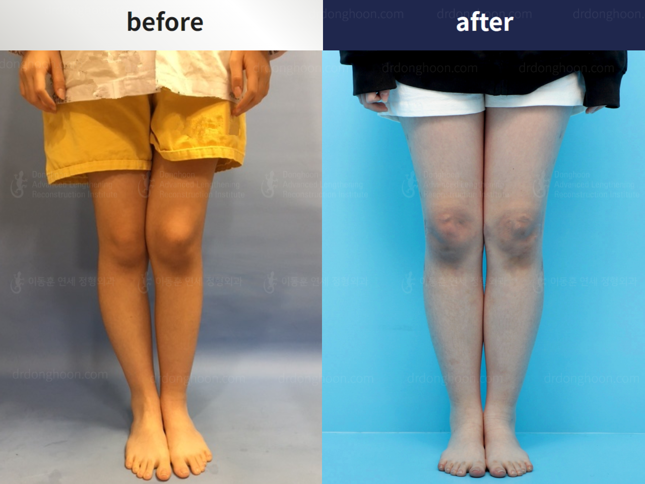 Before and after adult knock knees, case 5909612, image 1, Dr. Donghoon institute (DALRI)