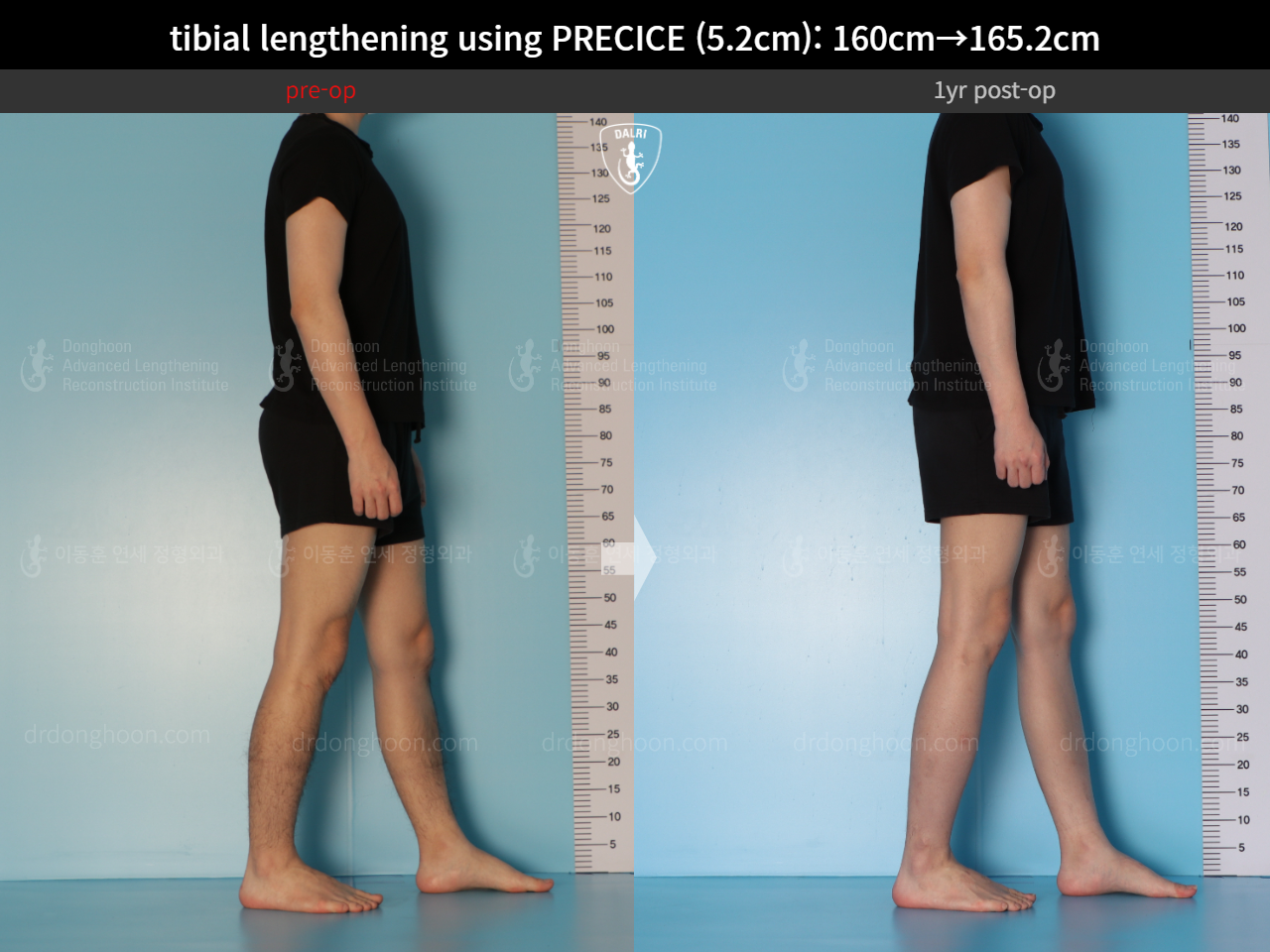 Before and after cll precice, case 15213098, image 6, Dr. Donghoon institute (DALRI)