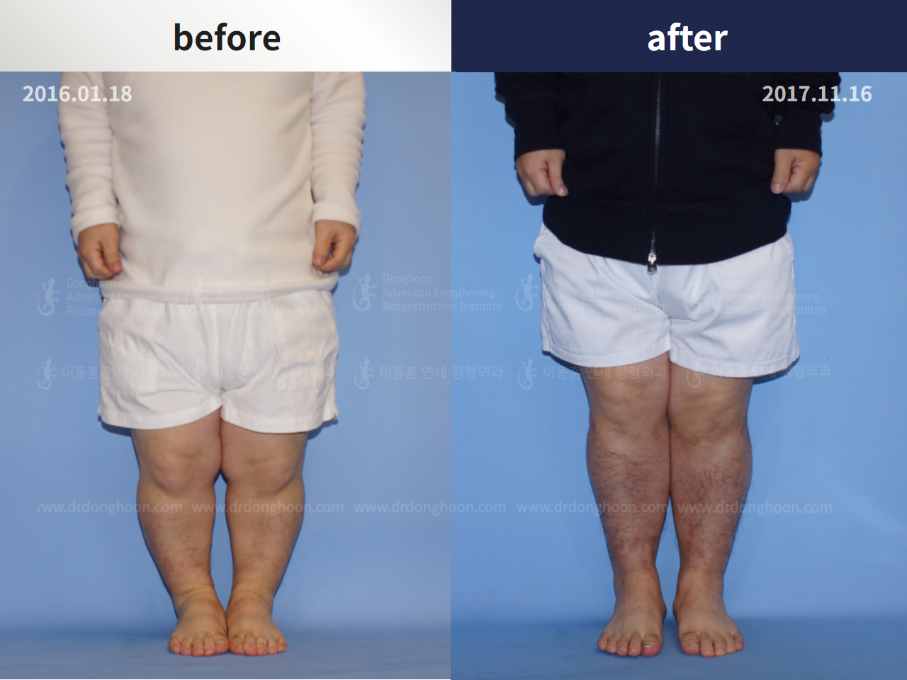 Before and after congenital condition, case 4300033, image 3, Dr. Donghoon institute (DALRI)