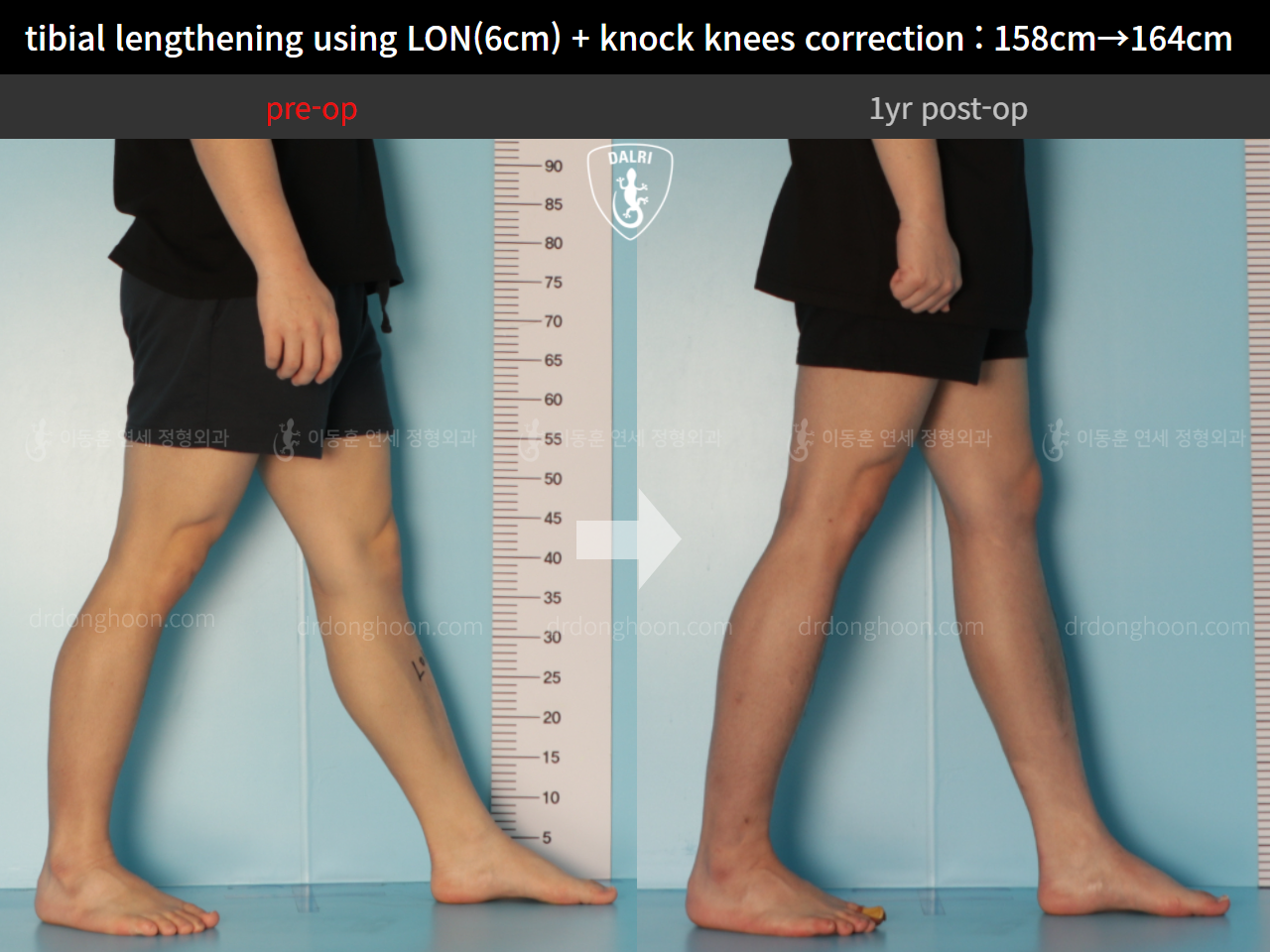 Before and after cll + deformity correction, case 9324521, image 7, Dr. Donghoon institute (DALRI)