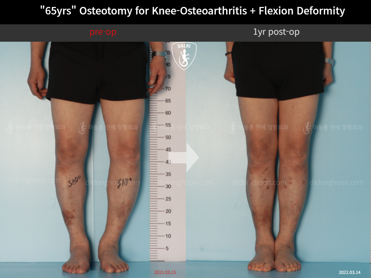 Before and after osteotomy for knee osteoarthritis, case 10742820, image 3, Dr. Donghoon institute (DALRI)