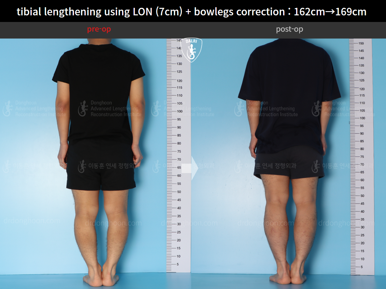 Before and after cll + deformity correction, case 15545055, image 2, Dr. Donghoon institute (DALRI)