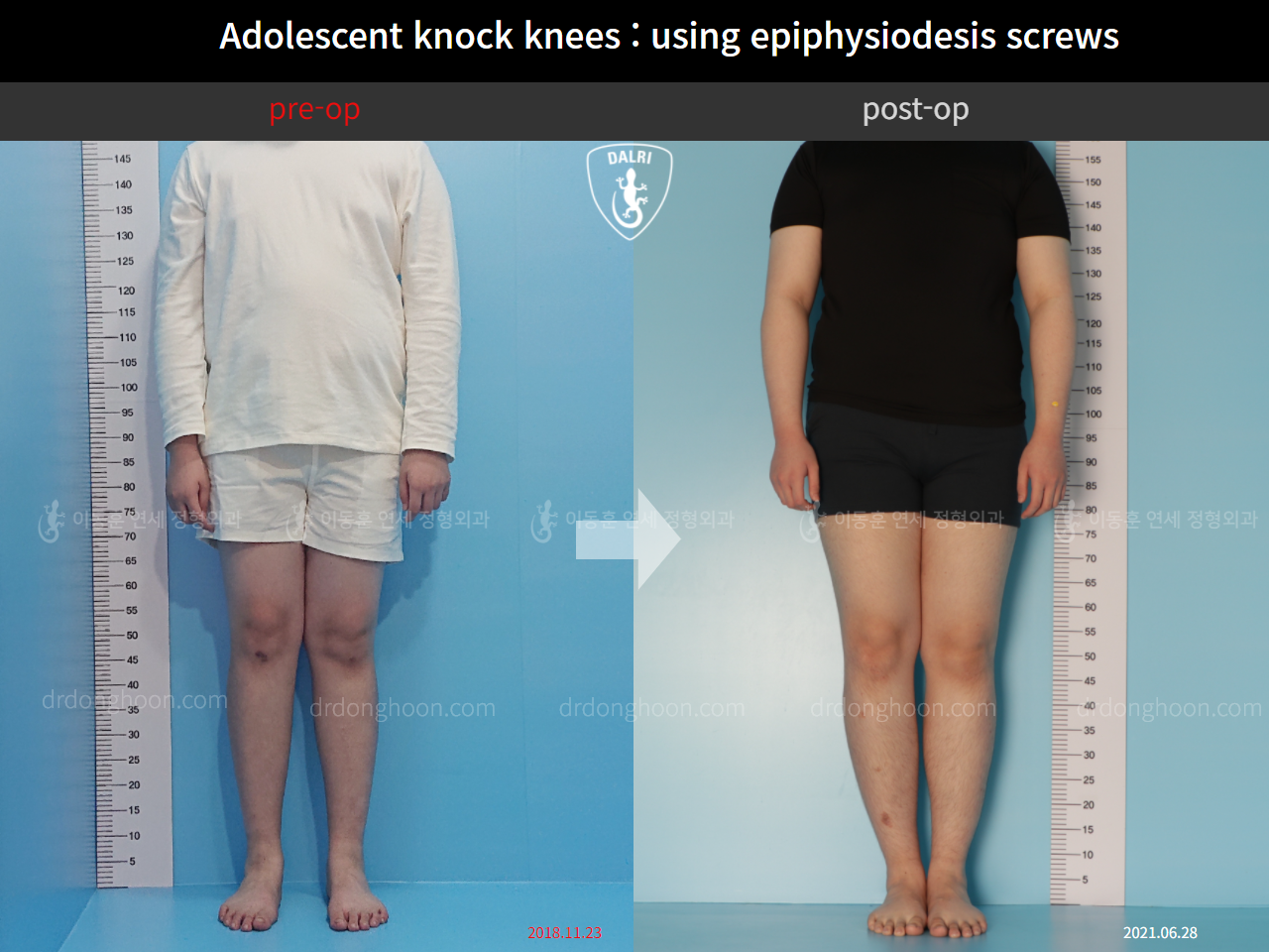 Before and after paediatric & adolescent knock knees, case 4310914, image 1, Dr. Donghoon institute (DALRI)