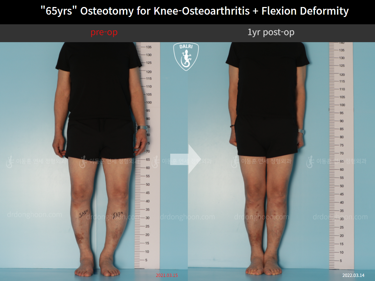 Before and after osteotomy for knee osteoarthritis, case 10742820, image 1, Dr. Donghoon institute (DALRI)