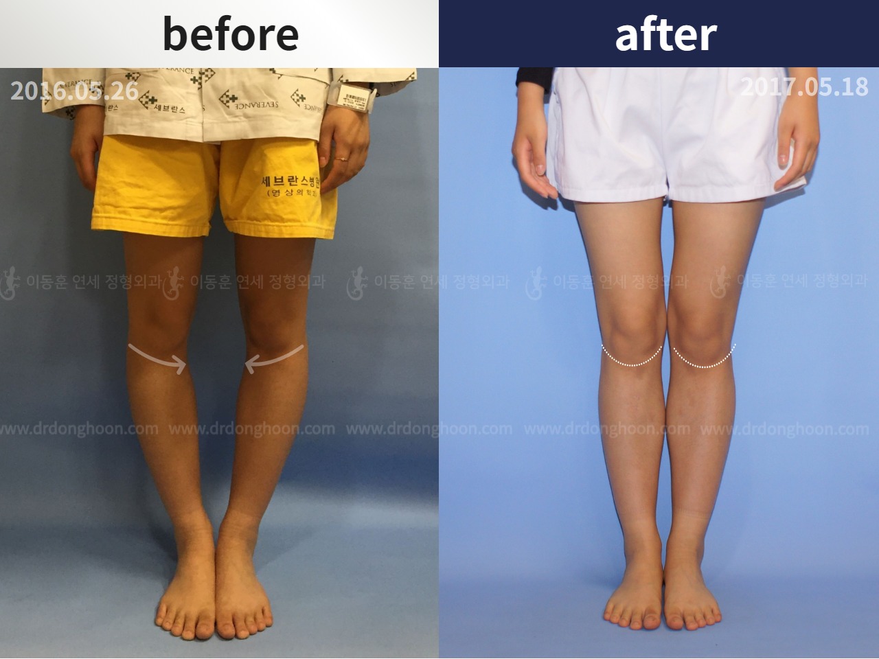Before and after paediatric & adolescent bowlegs, case 4320280, image 1, Dr. Donghoon institute (DALRI)