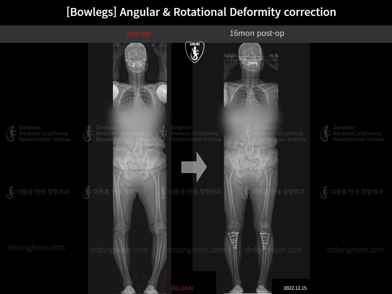 Before and after adult bowlegs, case 14637299, image 5, Dr. Donghoon institute (DALRI)