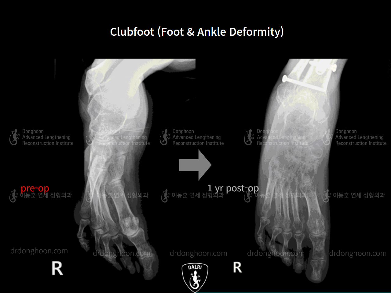 Before and after congenital condition, case 9231521, image 12, Dr. Donghoon institute (DALRI)
