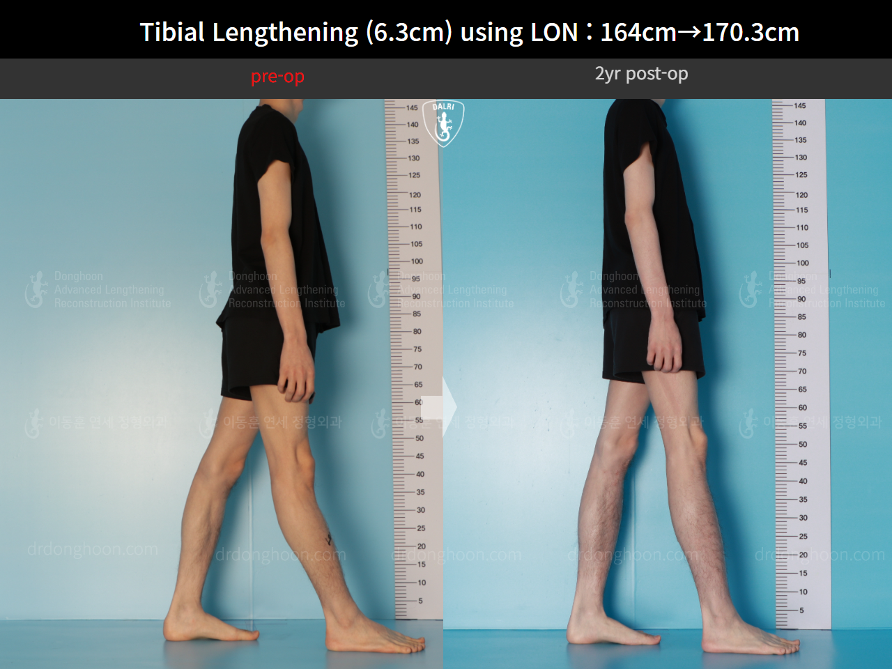 Before and after cll lon, case 16723608, image 5, Dr. Donghoon institute (DALRI)
