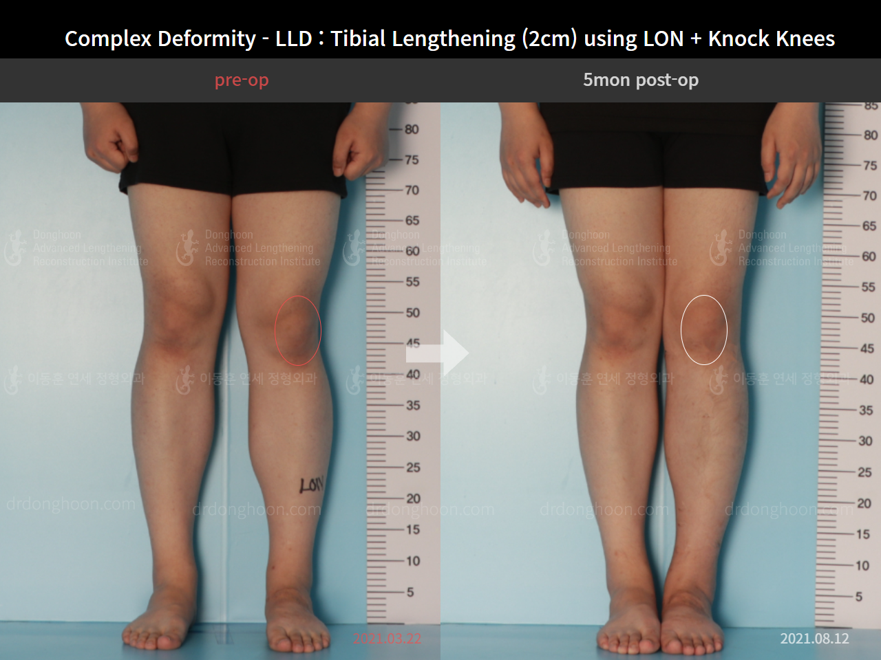Before and after complex deformity, case 8394665, image 3, Dr. Donghoon institute (DALRI)