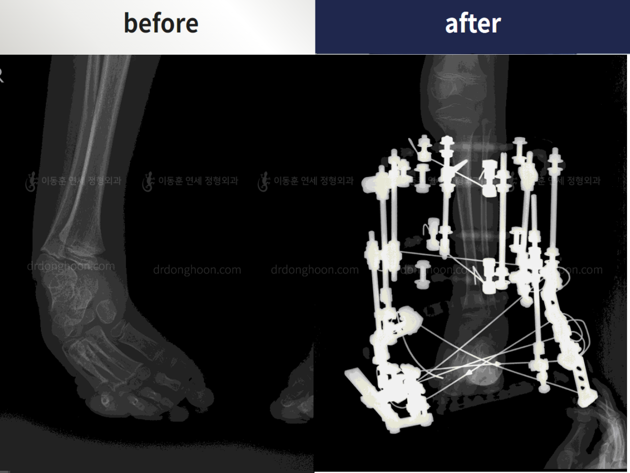 Before and after foot & ankle deformity, case 4367971, image 3, Dr. Donghoon institute (DALRI)