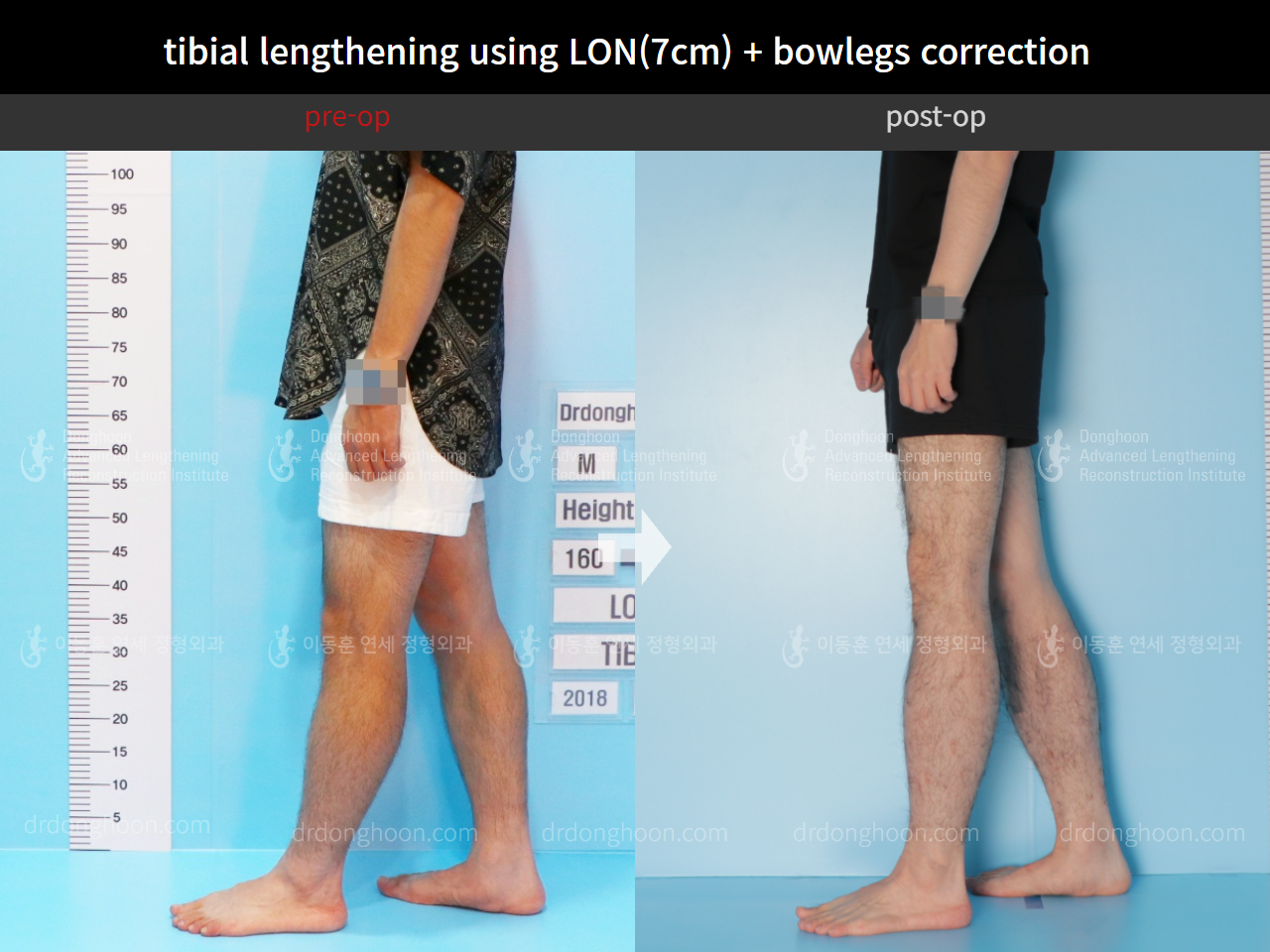 Before and after cll + deformity correction, case 4585644, image 8, Dr. Donghoon institute (DALRI)