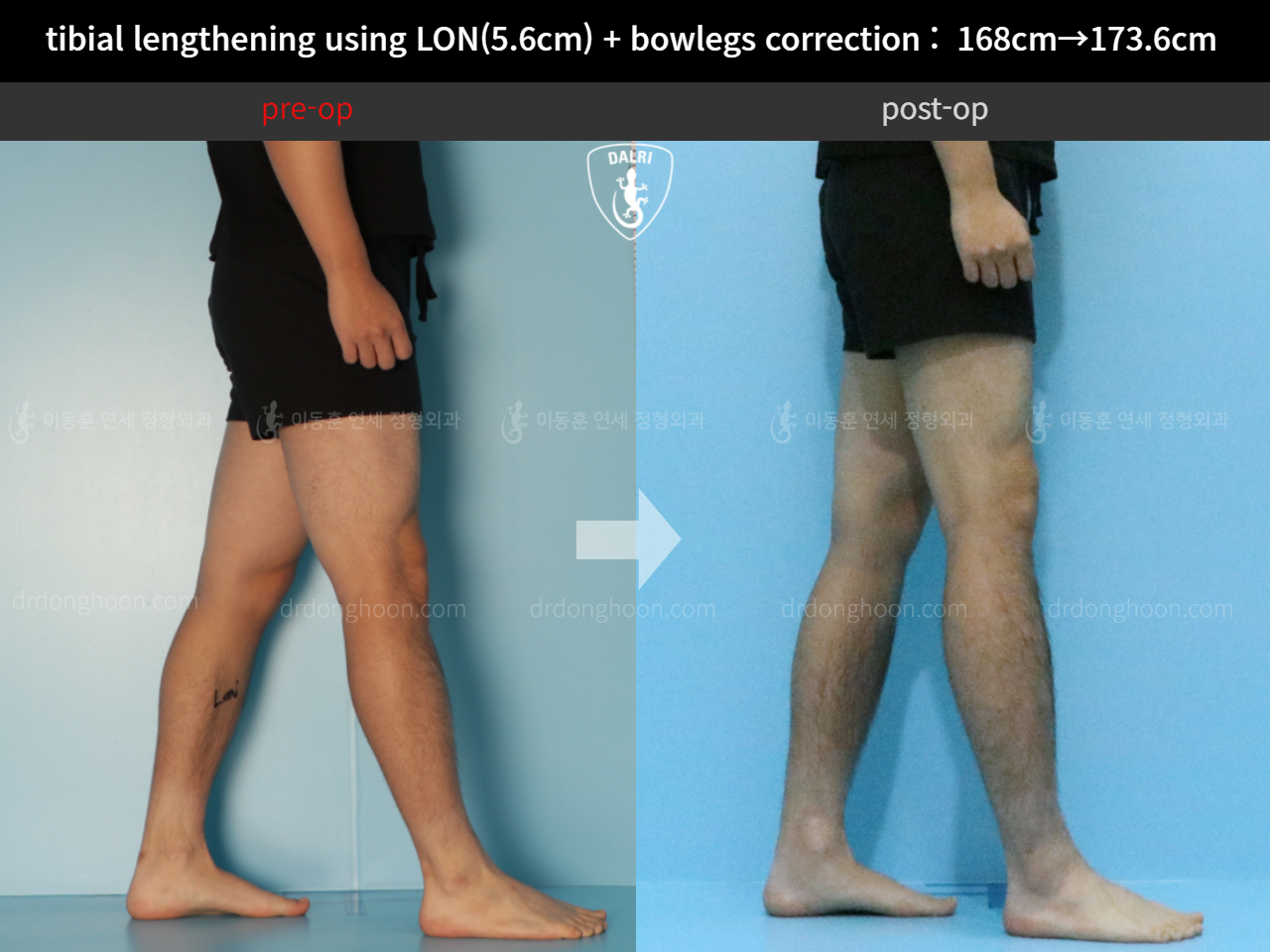 Before and after cll + deformity correction, case 11802994, image 7, Dr. Donghoon institute (DALRI)