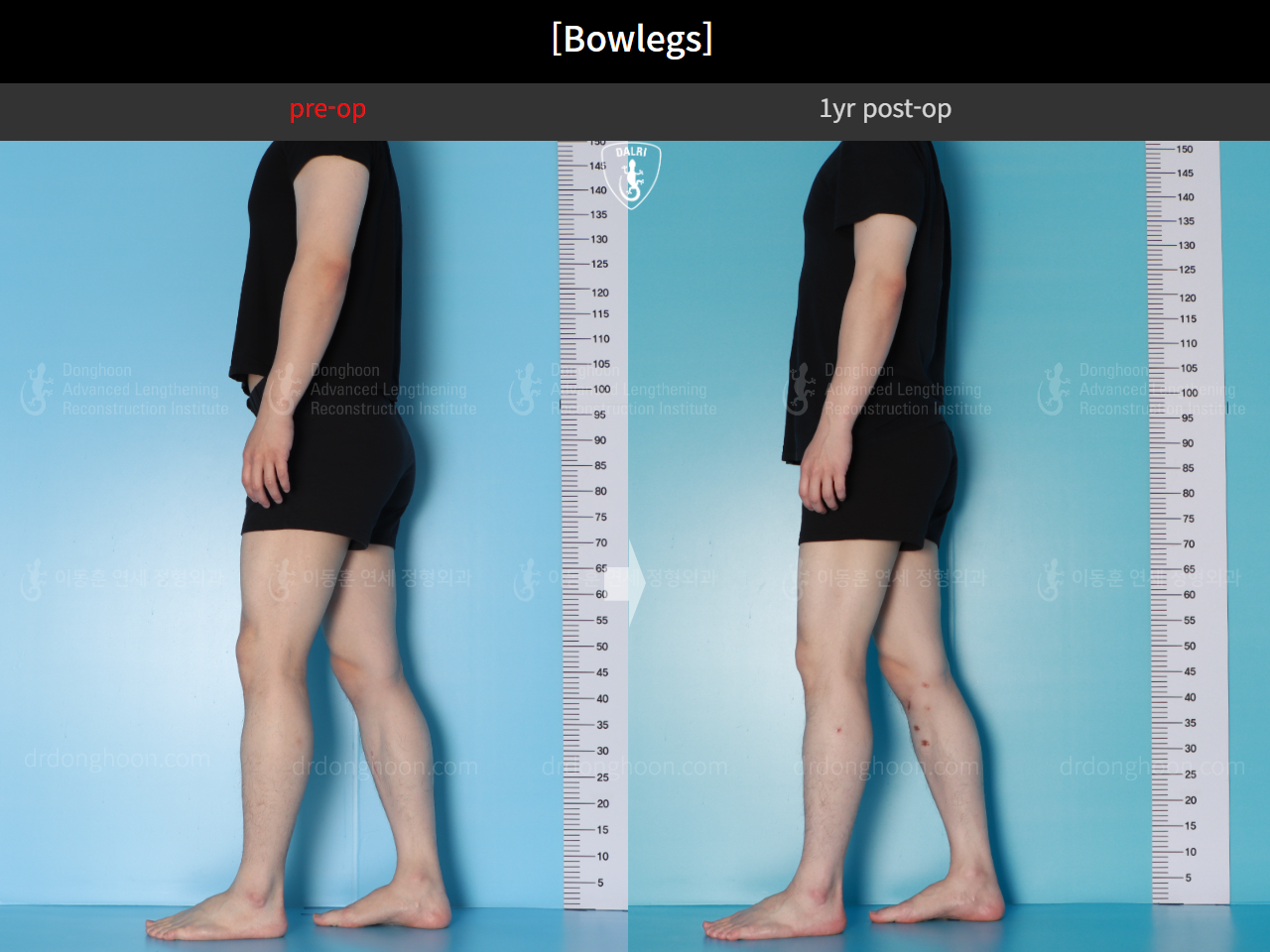 Before and after adult bowlegs, case 16724494, image 5, Dr. Donghoon institute (DALRI)