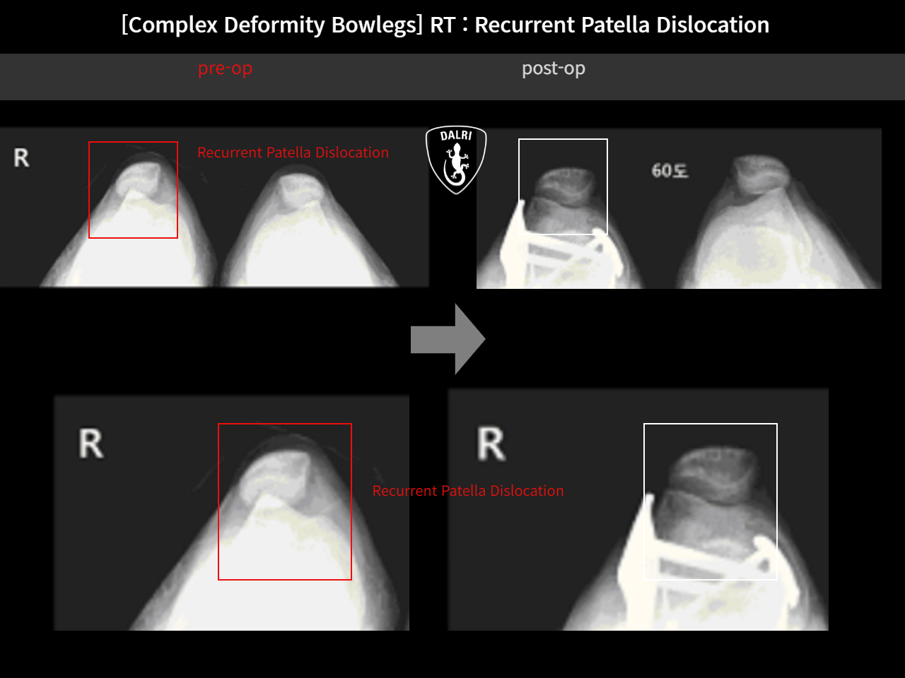 Before and after adult bowlegs, case 14960899, image 12, Dr. Donghoon institute (DALRI)