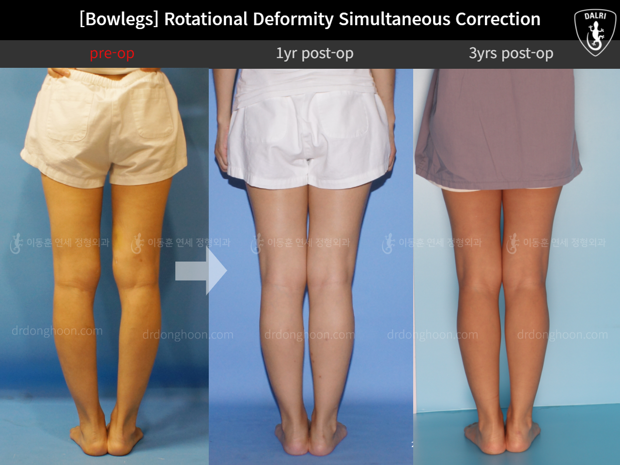 Before and after adult bowlegs, case 11789553, image 5, Dr. Donghoon institute (DALRI)