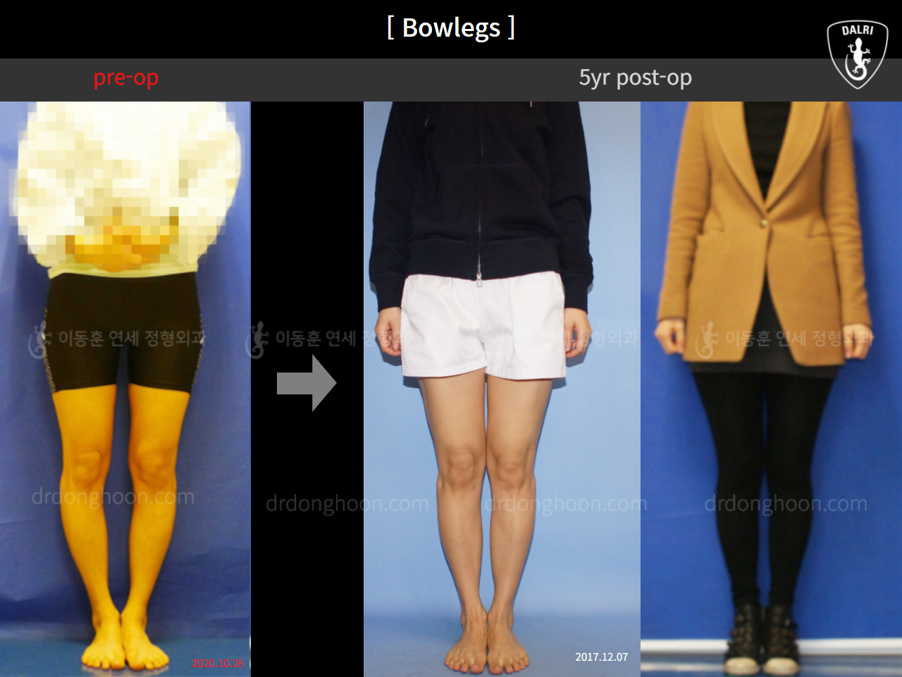 Before and after adult bowlegs, case 4311008, image 1, Dr. Donghoon institute (DALRI)