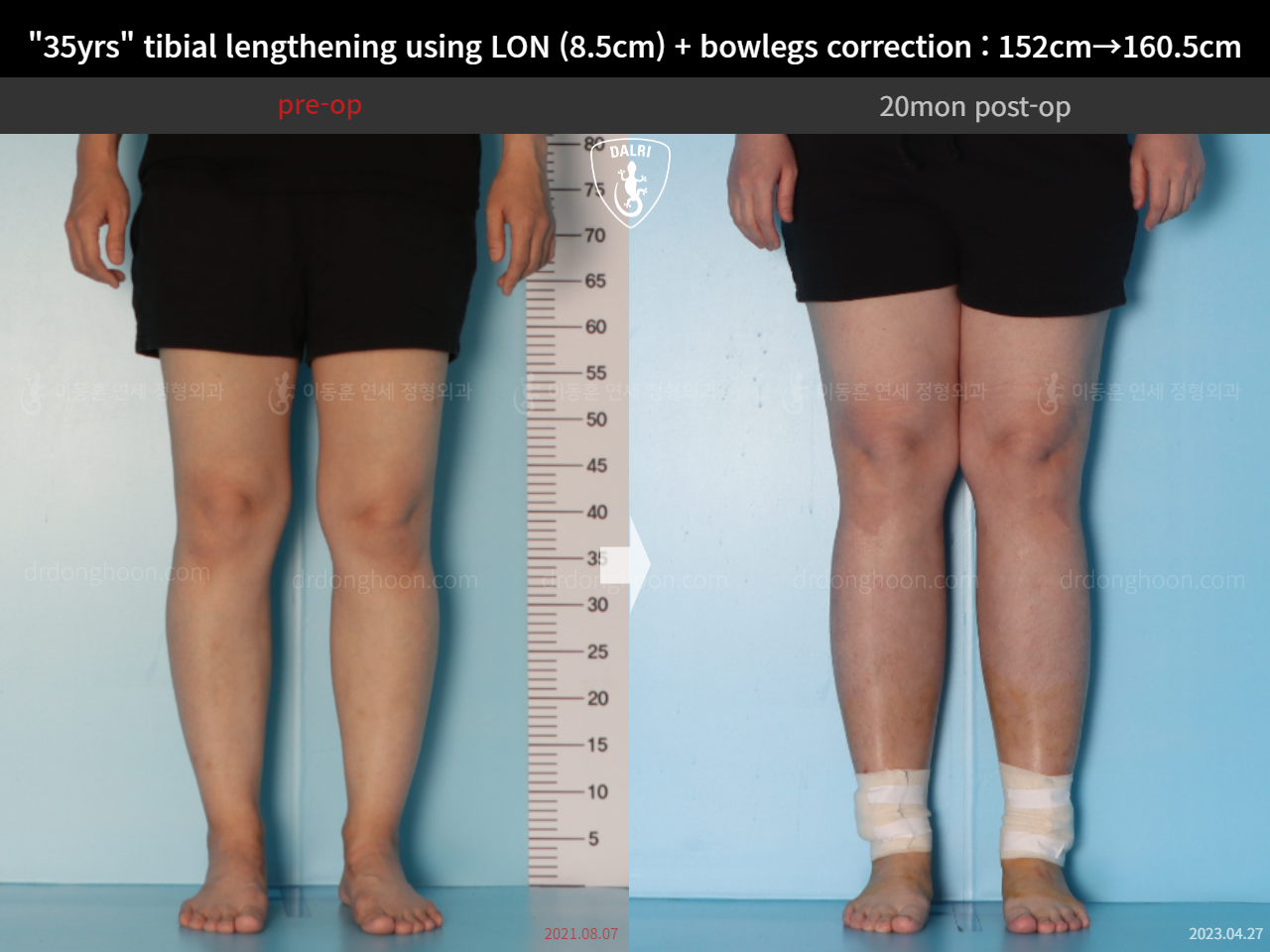 Before and after cll lon, case 15036651, image 6, Dr. Donghoon institute (DALRI)