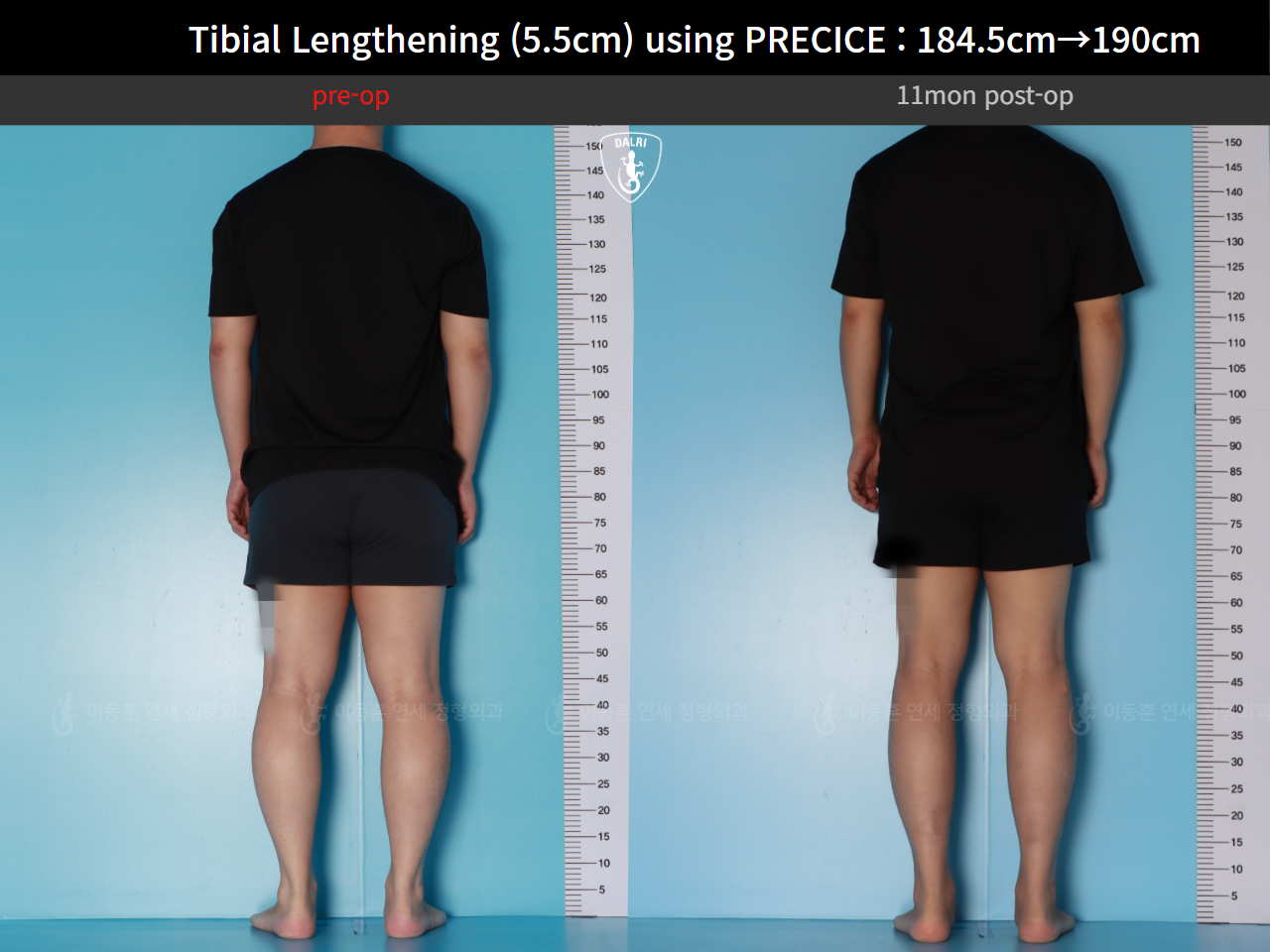 Before and after cll precice, case 125279355, image 4, Dr. Donghoon institute (DALRI)