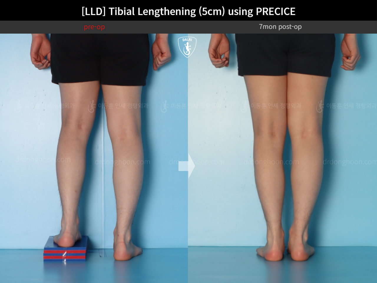 Before and after adult lld, case 18471613, image 6, Dr. Donghoon institute (DALRI)