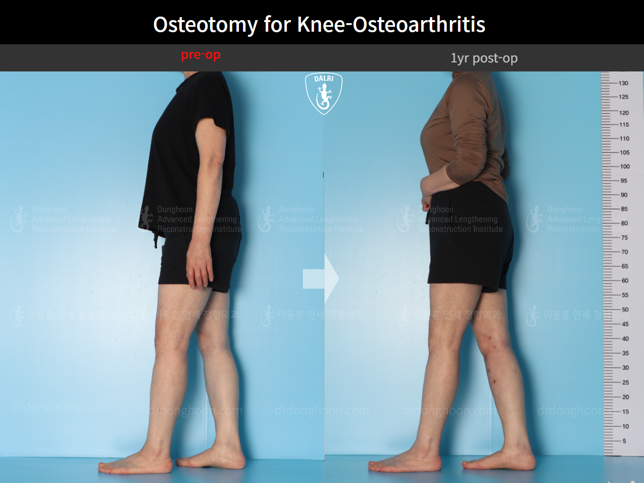 Before and after osteotomy for knee osteoarthritis, case 16893966, image 4, Dr. Donghoon institute (DALRI)