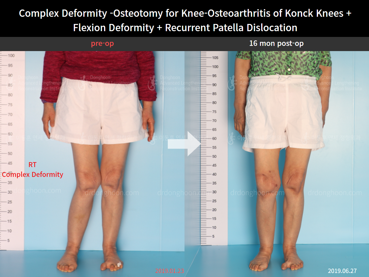 Before and after recurrent patella dislocation, case 8580605, image 1, Dr. Donghoon institute (DALRI)