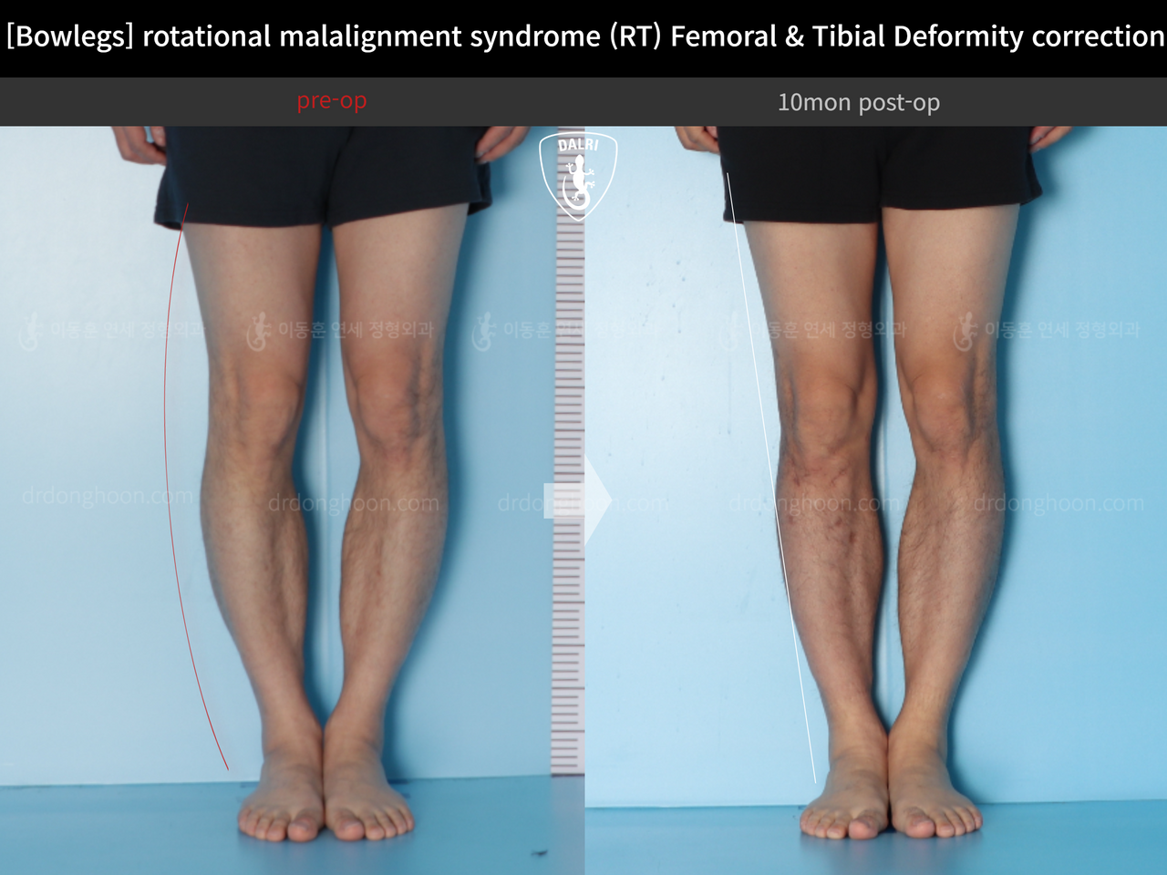 Before and after adult bowlegs, case 14220550, image 5, Dr. Donghoon institute (DALRI)