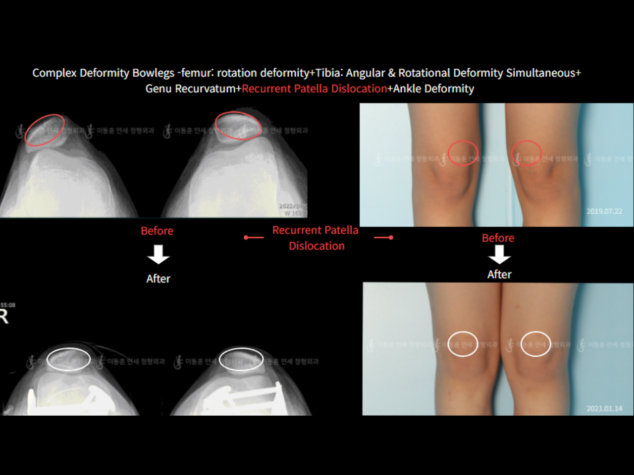 Before and after adult bowlegs, case 6883070, image 5, Dr. Donghoon institute (DALRI)
