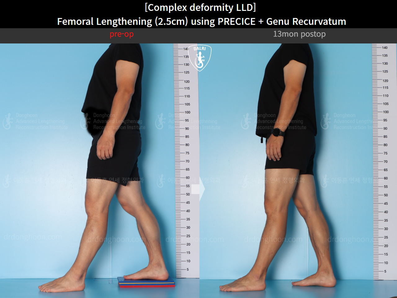 Before and after genu recurvatum, case 16854701, image 6, Dr. Donghoon institute (DALRI)