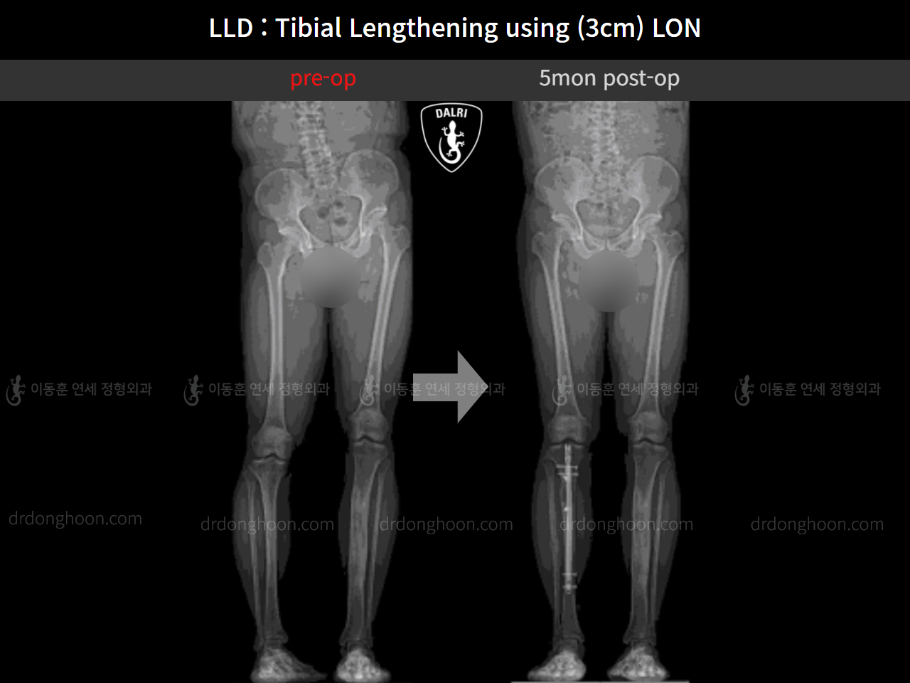 Before and after adult lld, case 11139768, image 9, Dr. Donghoon institute (DALRI)