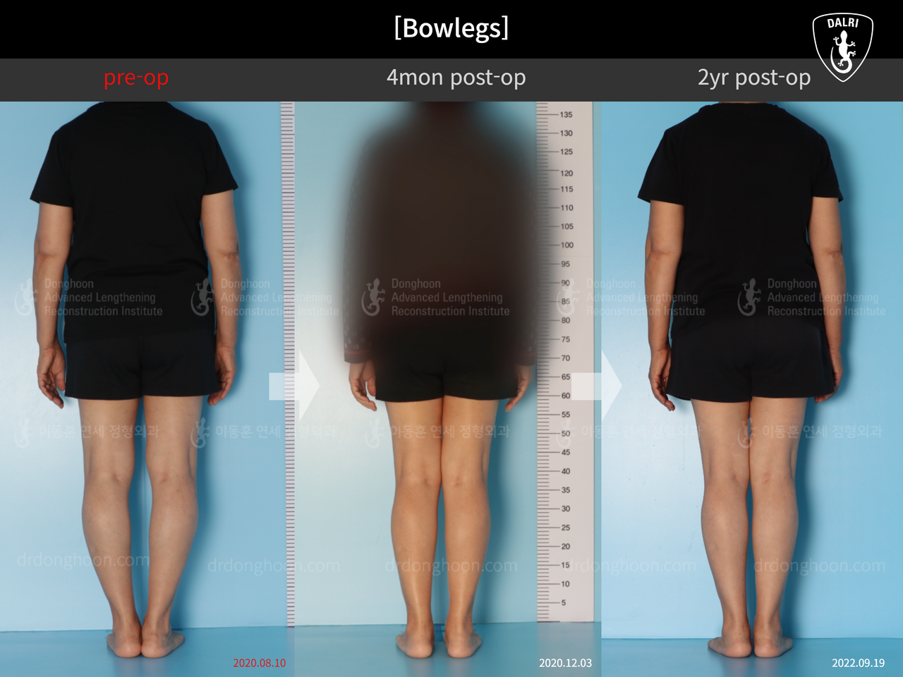 Before and after adult bowlegs, case 13250883, image 2, Dr. Donghoon institute (DALRI)
