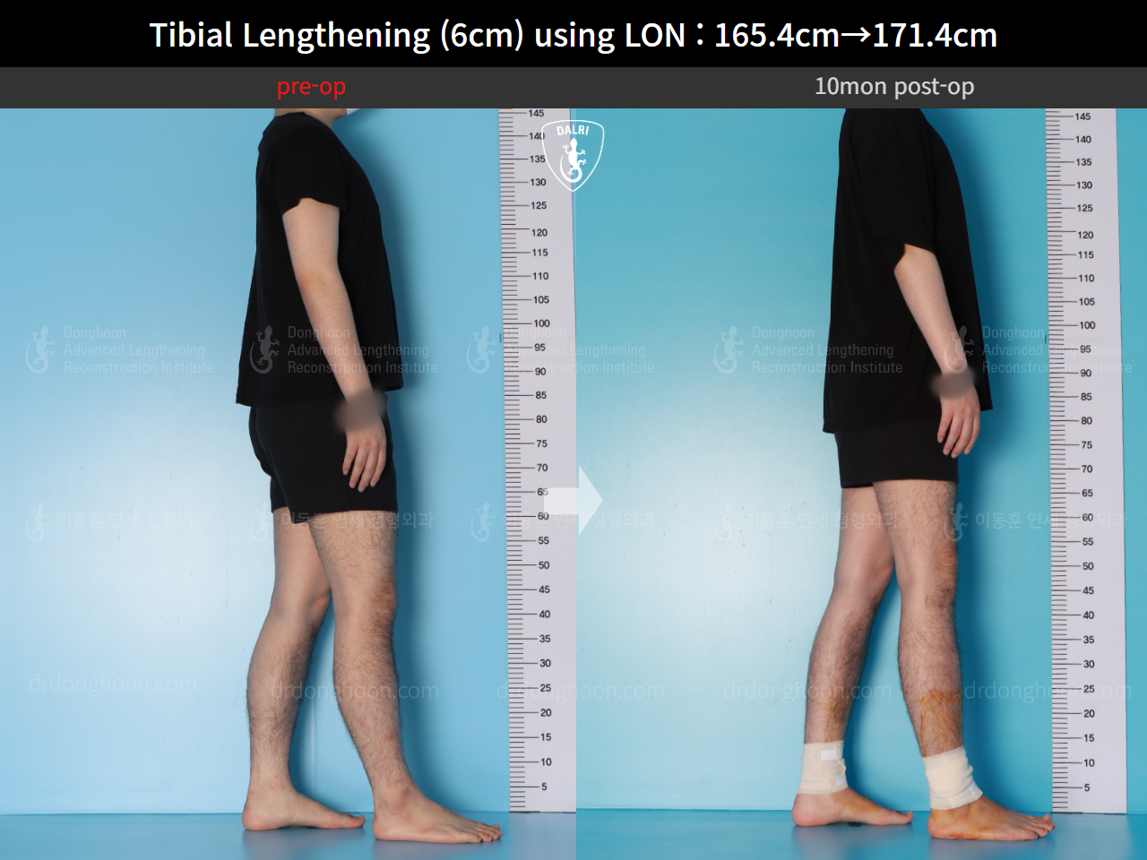 Before and after cll lon, case 15716525, image 7, Dr. Donghoon institute (DALRI)