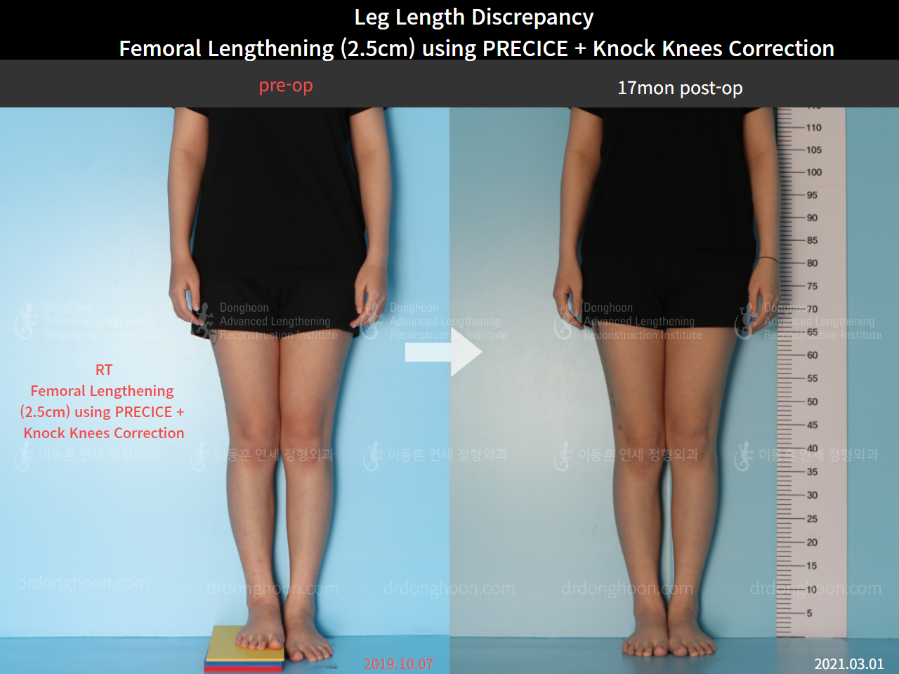 Before and after adult lld, case 8385191, image 1, Dr. Donghoon institute (DALRI)