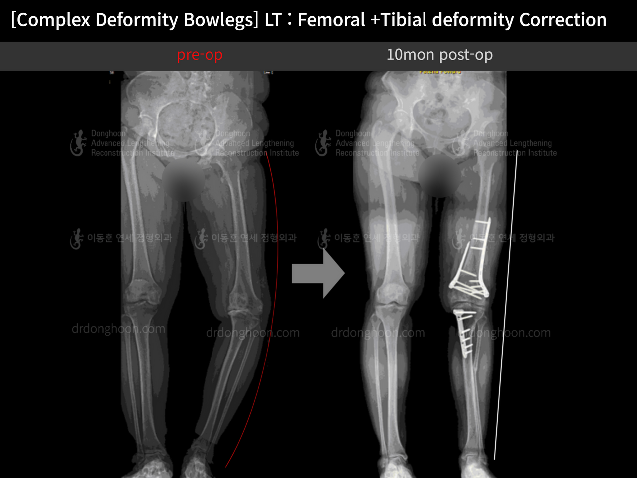 Before and after adult bowlegs, case 12790433, image 7, Dr. Donghoon institute (DALRI)