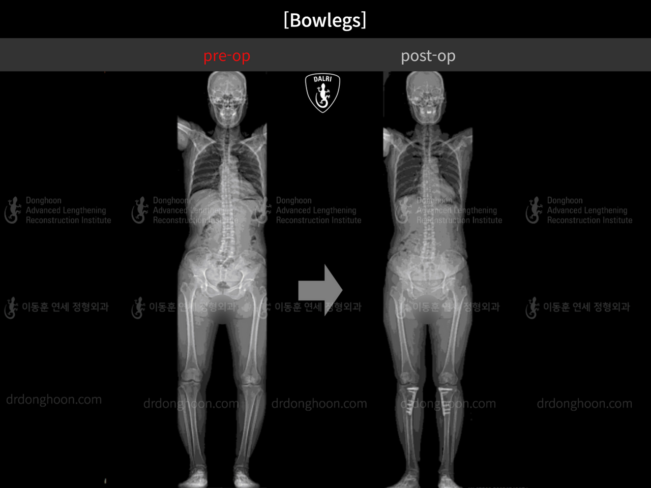 Before and after adult bowlegs, case 13223508, image 7, Dr. Donghoon institute (DALRI)