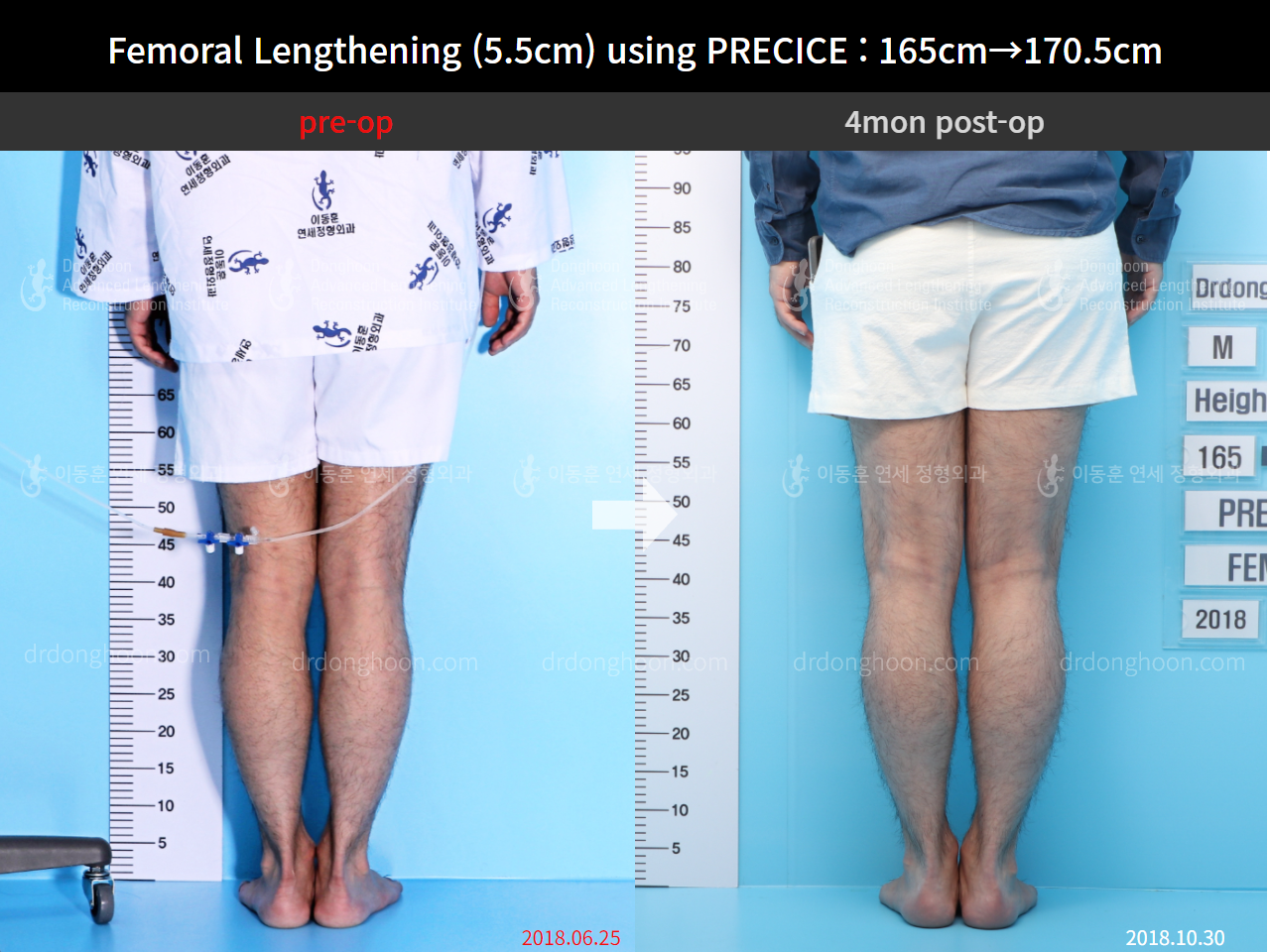 Before and after cll precice, case 4323379, image 4, Dr. Donghoon institute (DALRI)