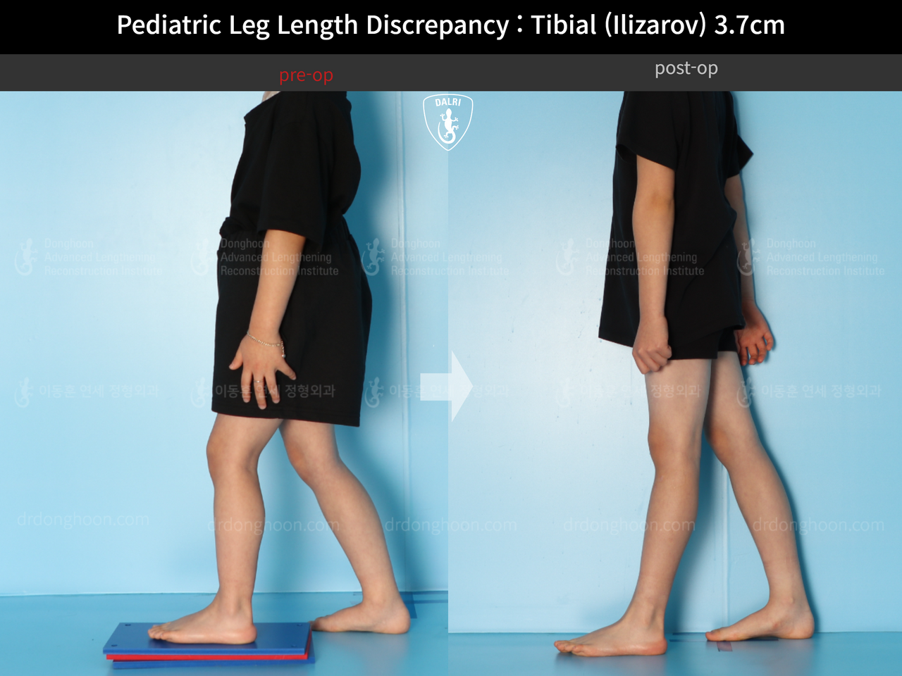 Before and after paediatric & adolescent lld, case 14220900, image 3, Dr. Donghoon institute (DALRI)