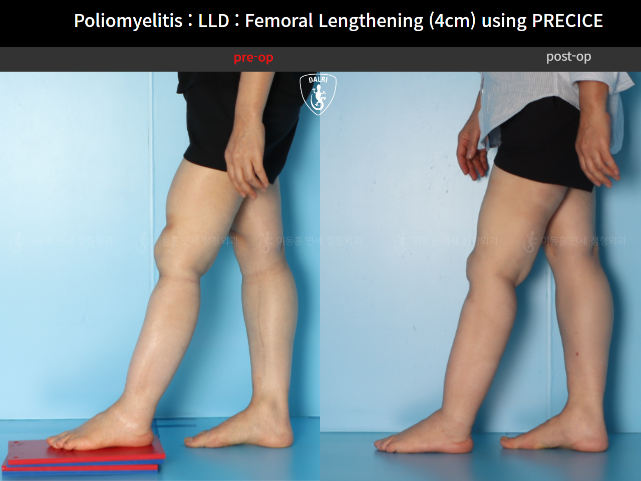 Before and after congenital condition, case 91244014, image 6, Dr. Donghoon institute (DALRI)
