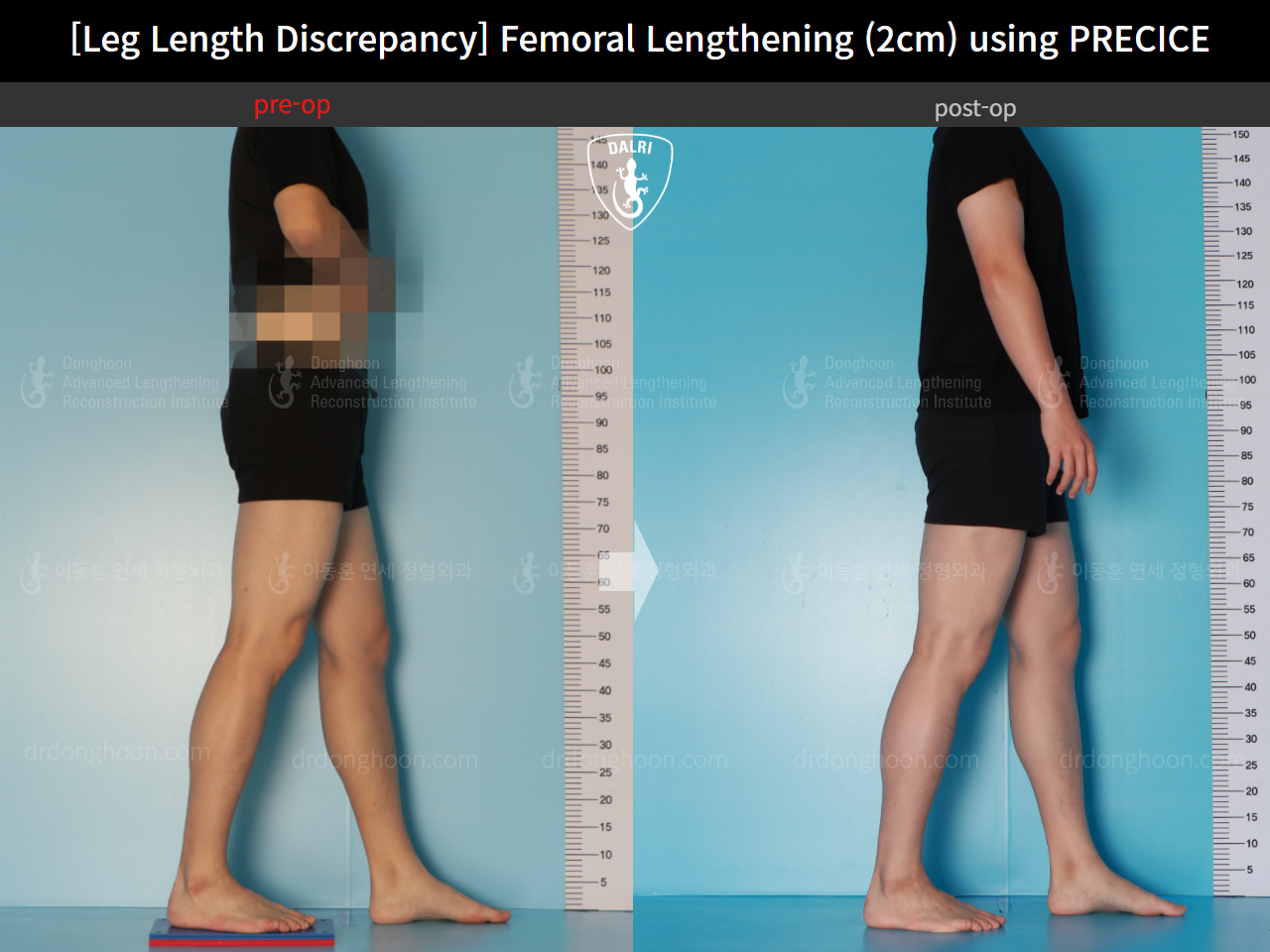 Before and after adult lld, case 16061128, image 4, Dr. Donghoon institute (DALRI)