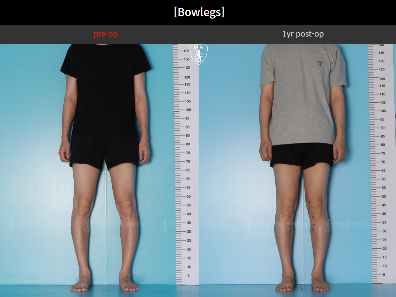 Before and after adult bowlegs, case 125438866, image 7, Dr. Donghoon institute (DALRI)