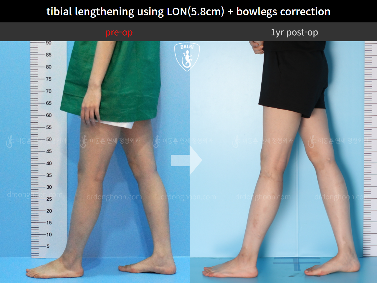 Before and after cll lon, case 4577846, image 8, Dr. Donghoon institute (DALRI)