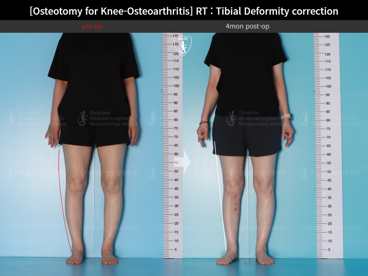 Before and after osteotomy for knee osteoarthritis, case 17890677, image 3, Dr. Donghoon institute (DALRI)