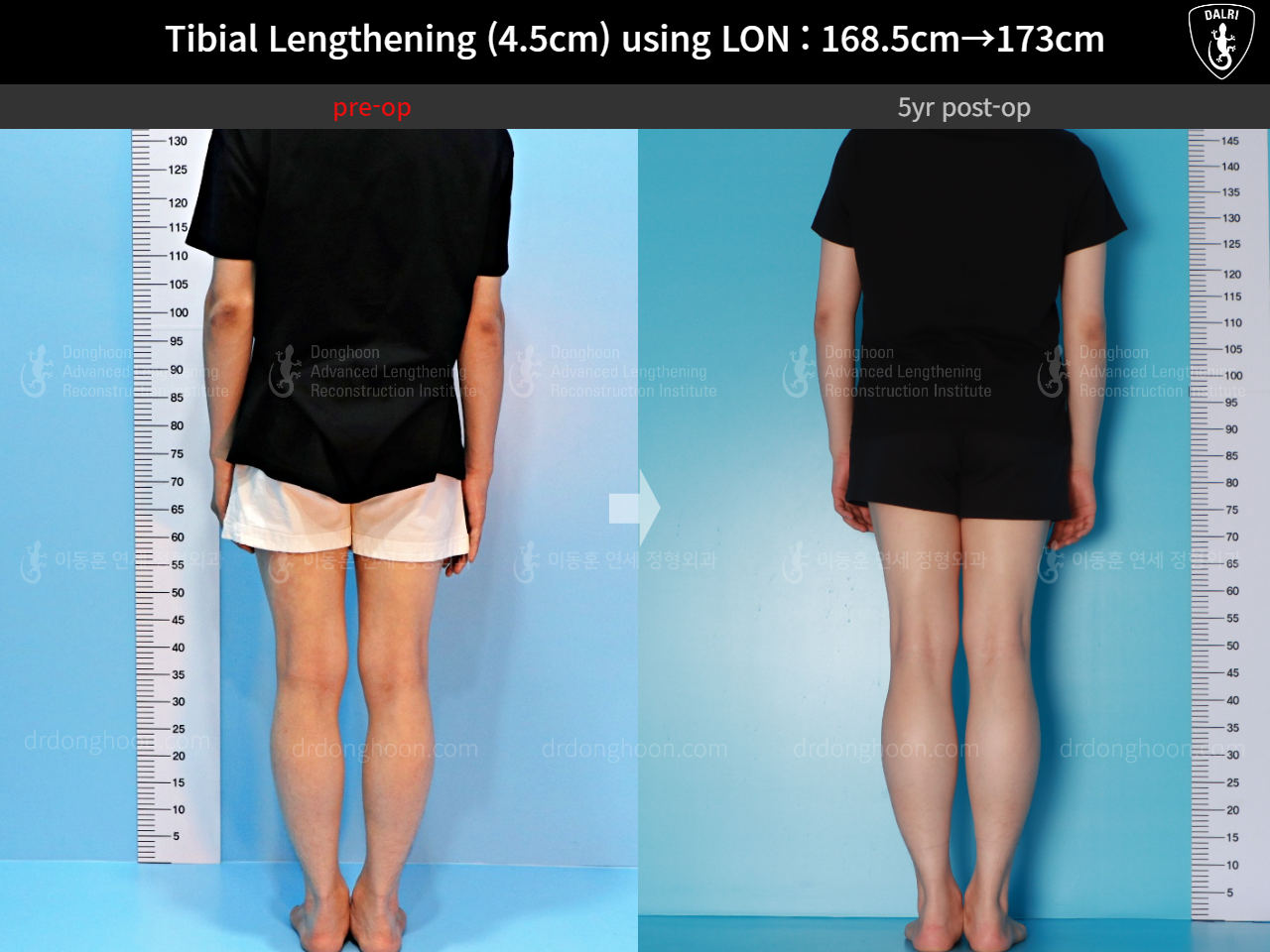 Before and after cll lon, case 16140967, image 4, Dr. Donghoon institute (DALRI)